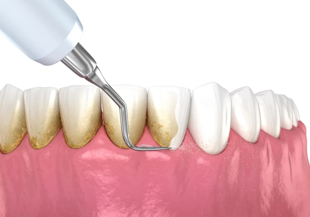 Dental Scaling