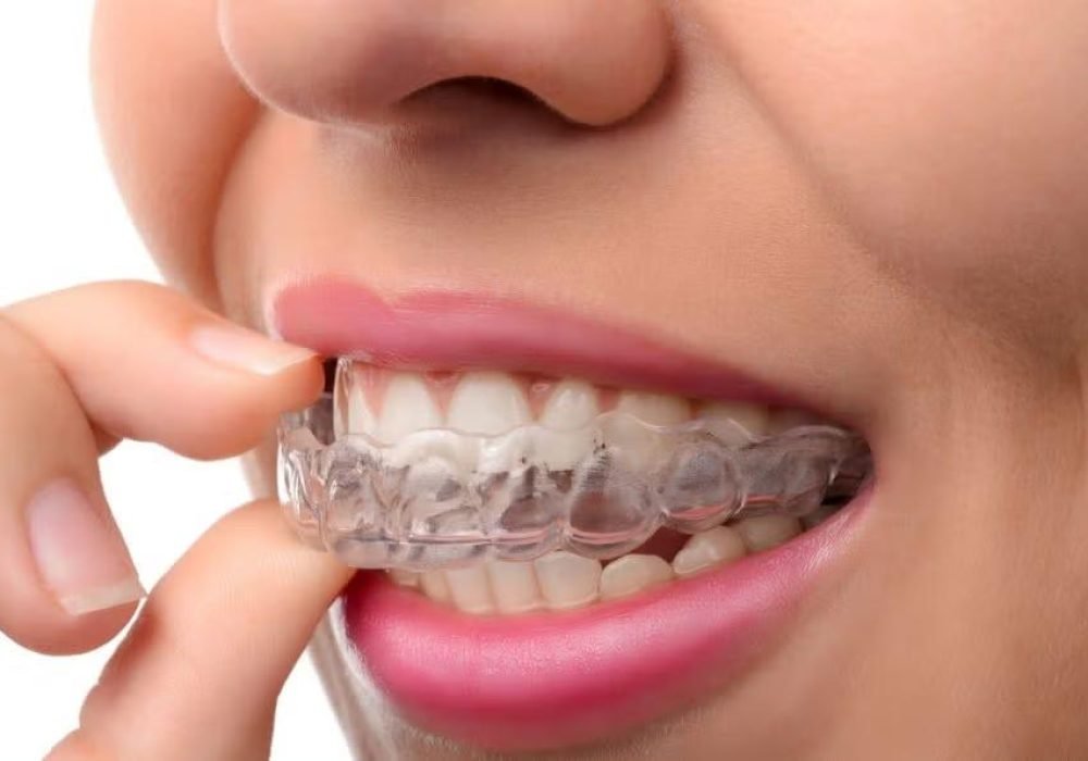 tooth alignment 1